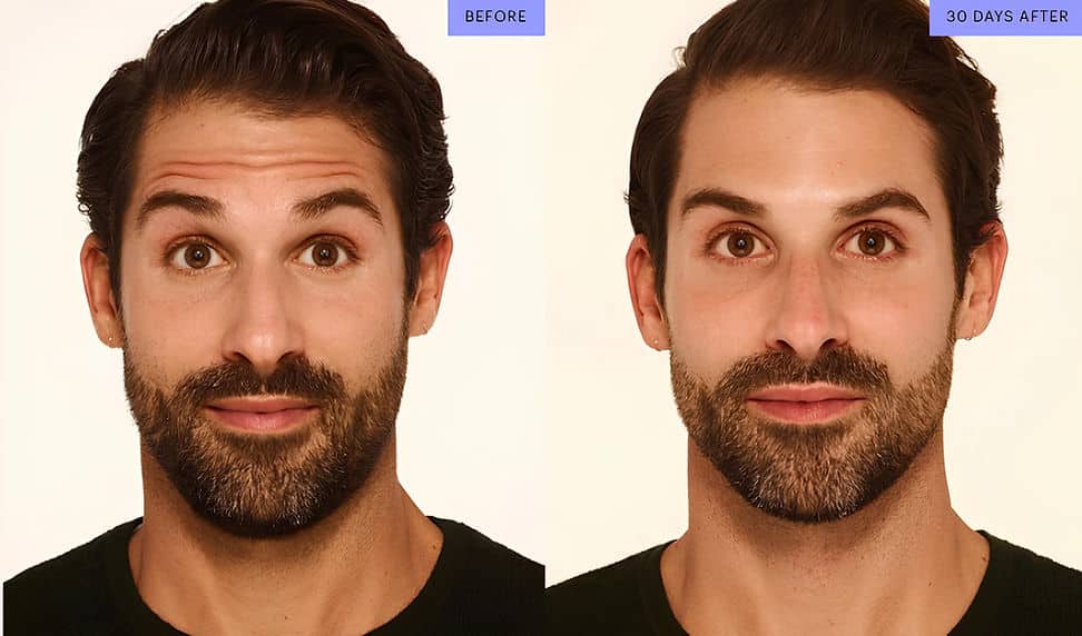Before and After Image: Botox - front
