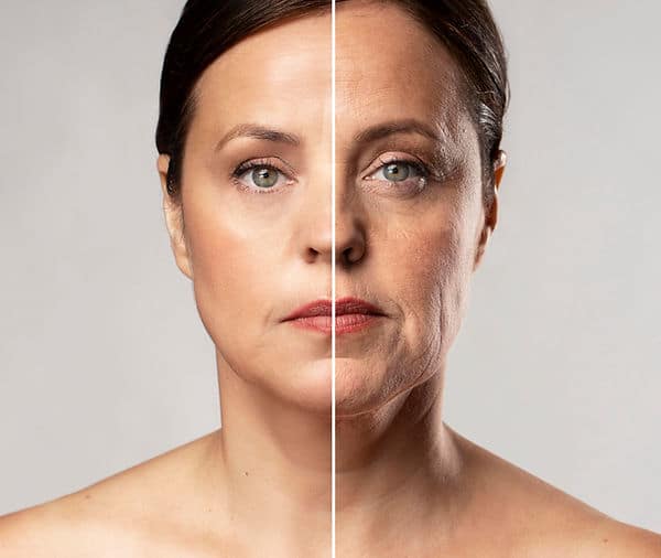 Before and After Image: Botox - front