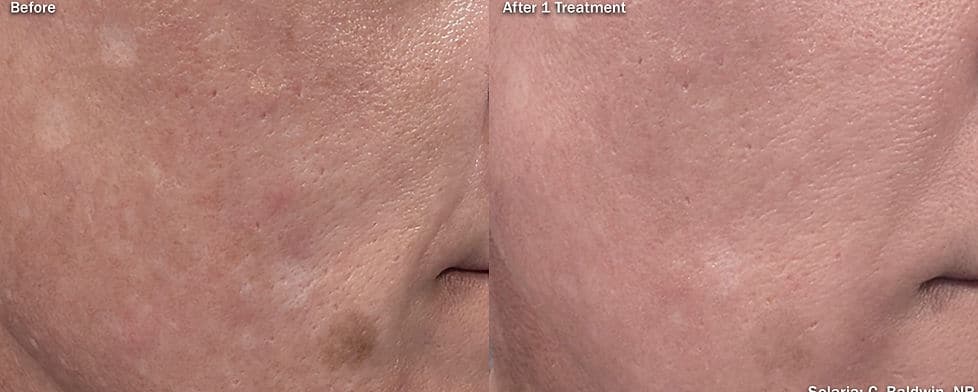 Before and After Image: Solaria - right-front-oblique