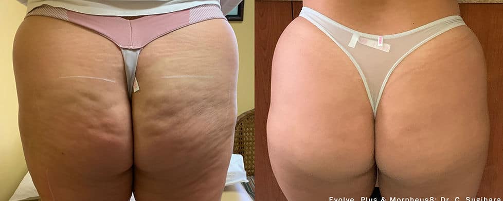 Before and After Image: Evolve - back