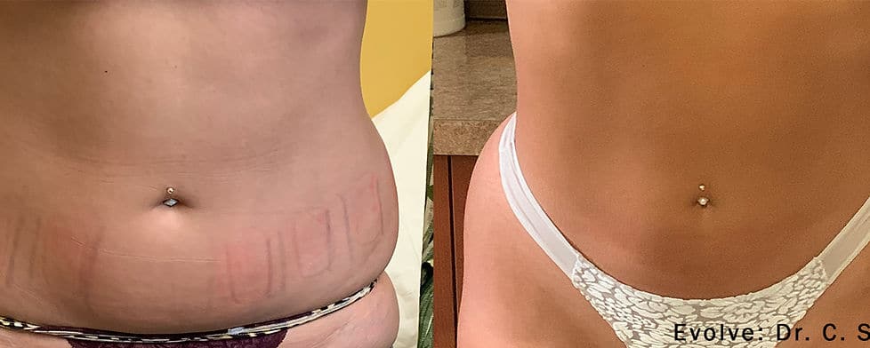 Before and After Image: Evolve - front