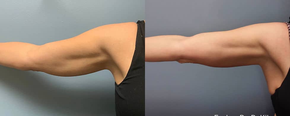Before and After Image: Evolve - front