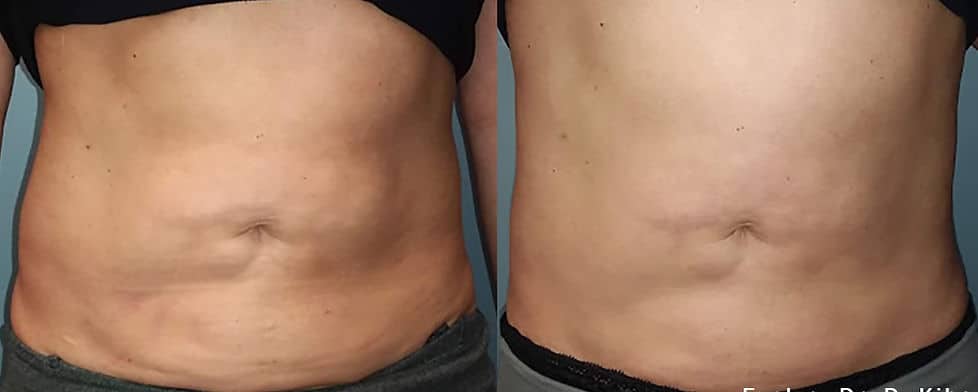 Before and After Image: Evolve - front