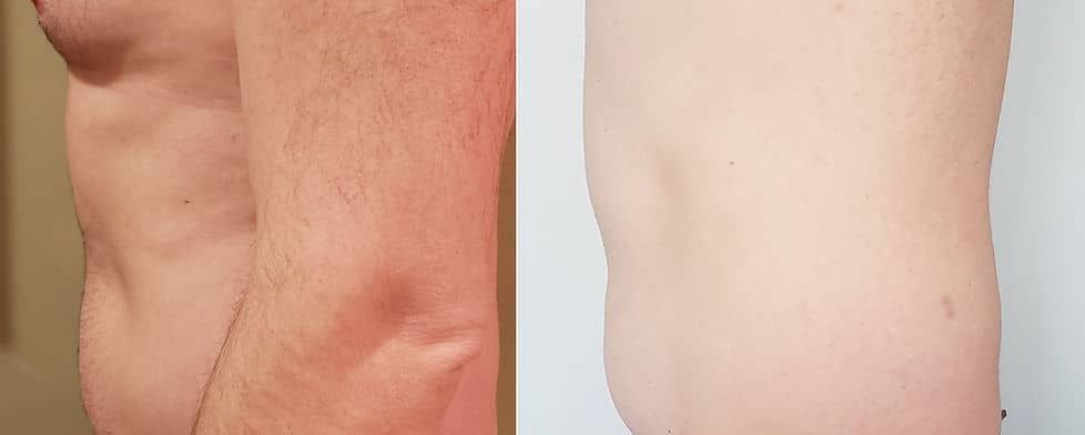Before and After Image: Evolve - left-side