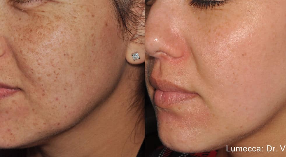 Before and After Image: Lumecca - left-front-oblique