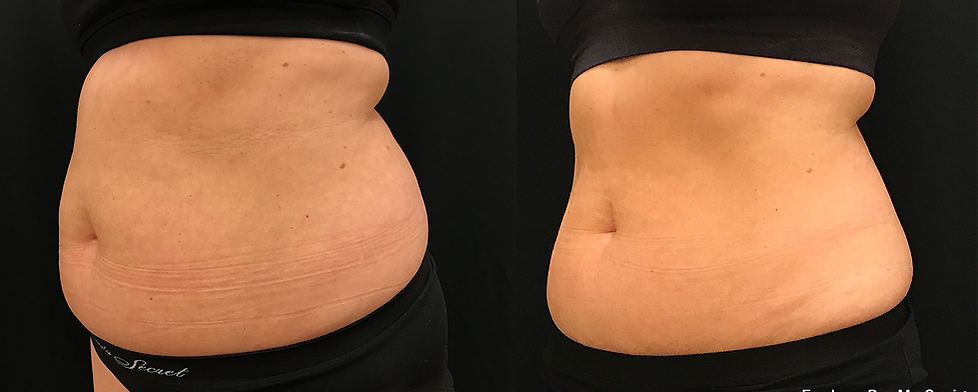 Before and After Image: Evolve - left-front-oblique