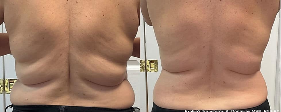 Before and After Image: Evolve - back