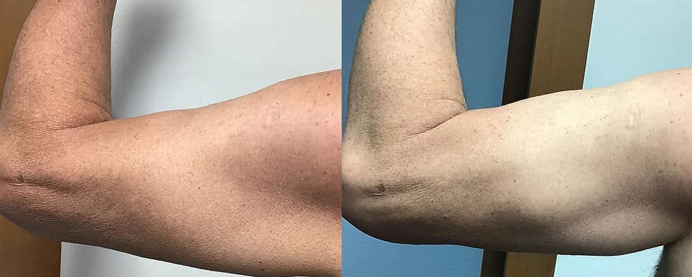 Before and After Image: Evolve - back