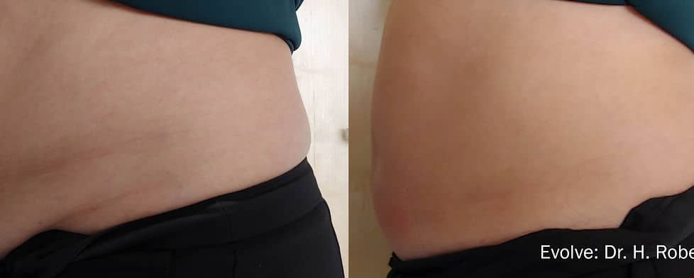 Before and After Image: Evolve - left-side