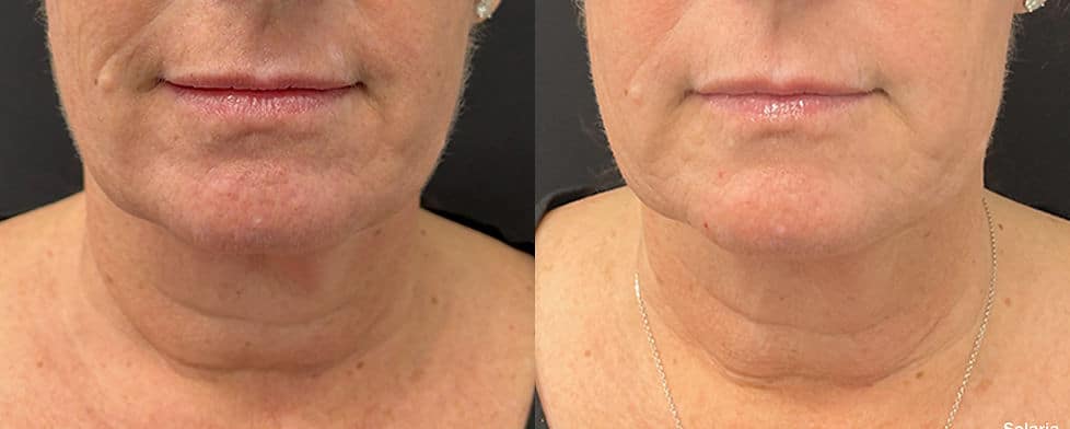 Before and After Image: Solaria - front