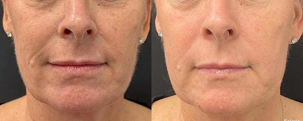 Before and After Image: Solaria - front