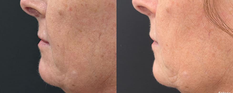 Before and After Image: Solaria - left-side