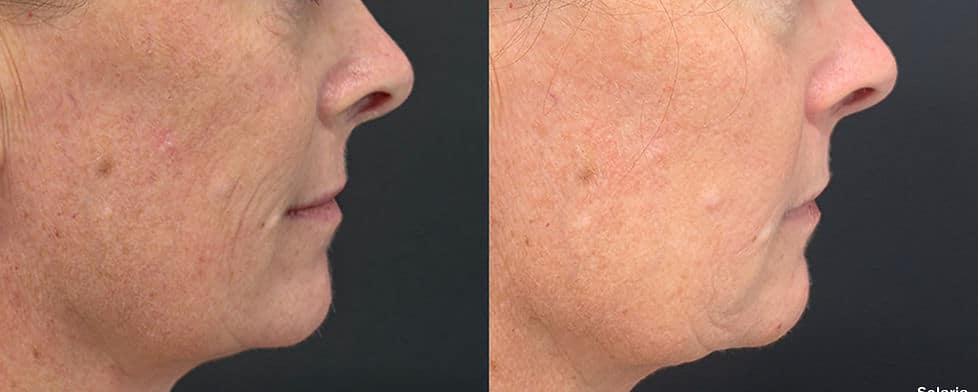 Before and After Image: Solaria - right-side