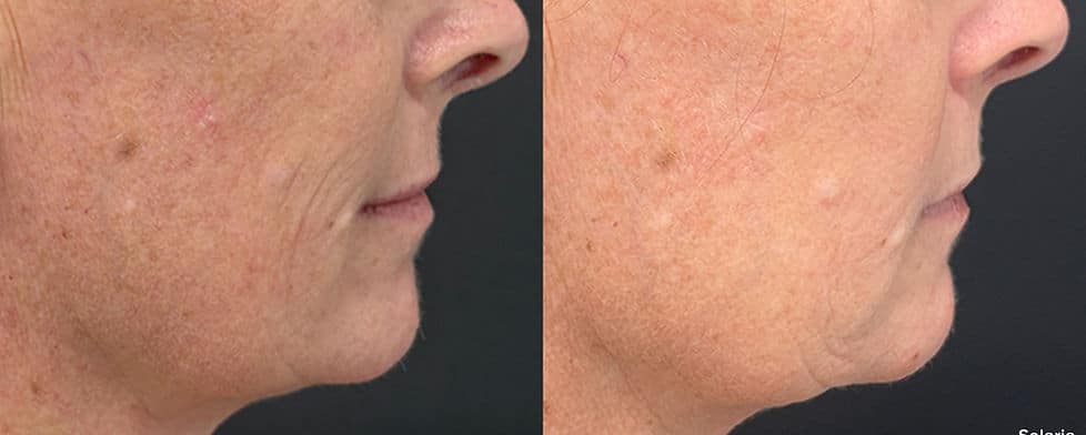Before and After Image: Solaria - right-side