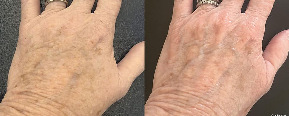 Before and After Image: Solaria - front