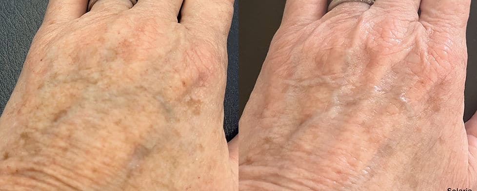 Before and After Image: Solaria - front
