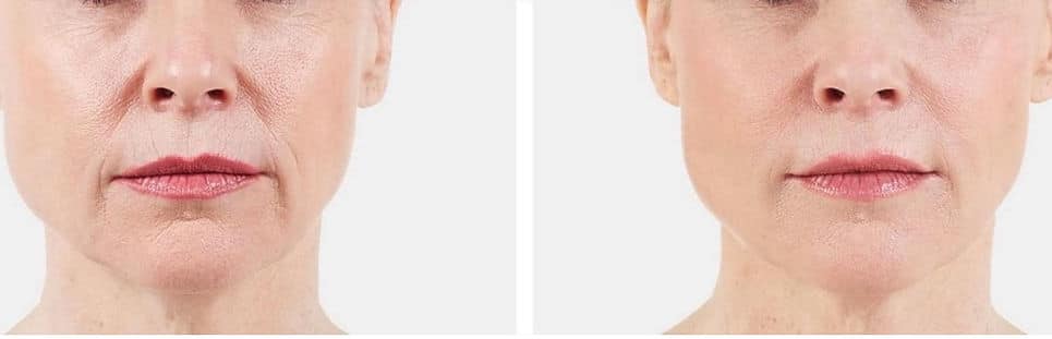 Before and After Image: Juvederm - front