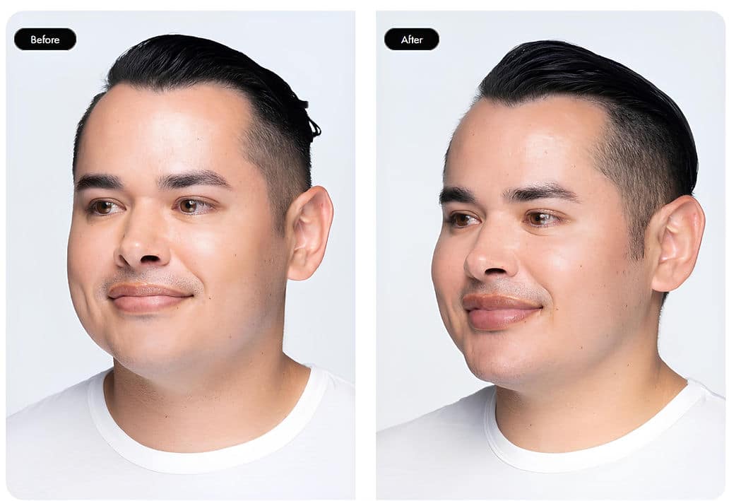 Before and After Image: Lip & Dermal Fillers - left-front-oblique