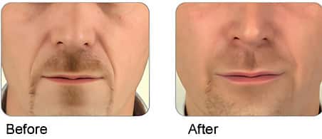 Before and After Image: Lip & Dermal Fillers - front