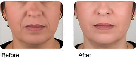 Before and After Image: Lip & Dermal Fillers - front