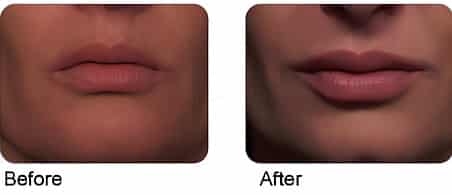 Before and After Image: Lip & Dermal Fillers - front