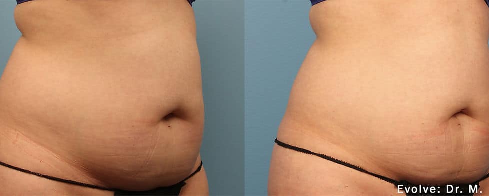 Before and After Image: Evolve - right-front-oblique
