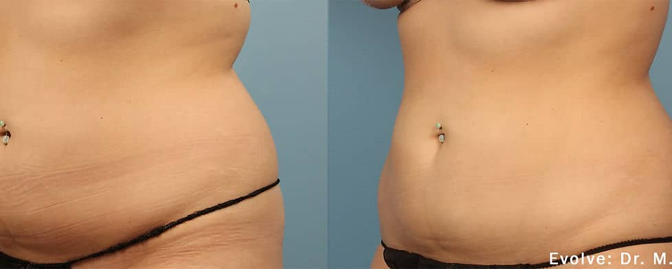 Before and After Image: Evolve - left-front-oblique