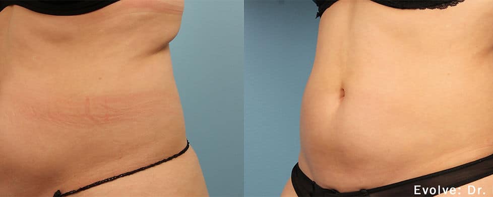Before and After Image: Evolve - left-front-oblique