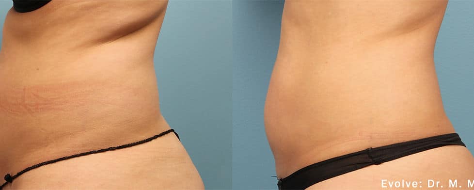 Before and After Image: Evolve - left-side