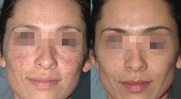 Before and After Image: Lumecca - right-front-oblique