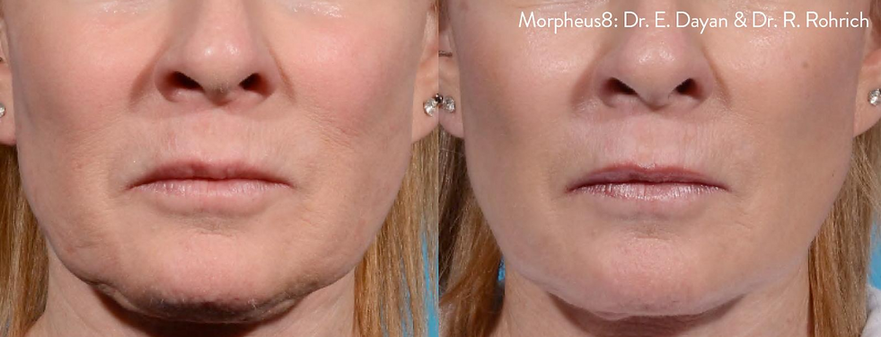 Before and After Image: Morpheus8 - front