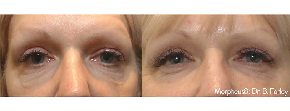 Before and After Image: Morpheus8 - front