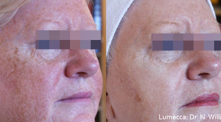Before and After Image: Lumecca - right-front-oblique