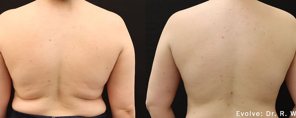 Before and After Image: Evolve - back