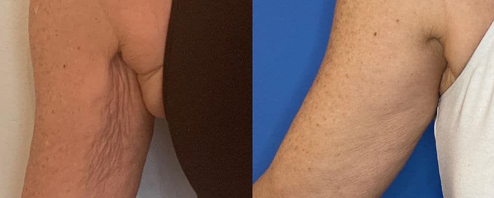 Before and After Image: Evolve - front