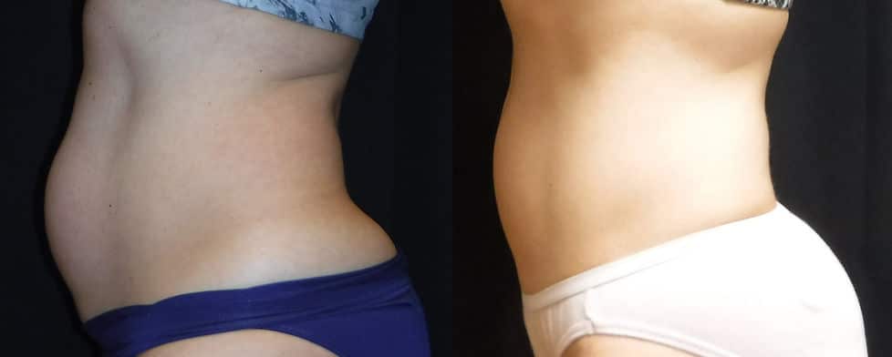 Before and After Image: Evolve - left-side