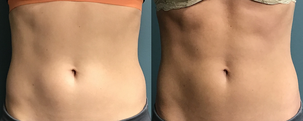 Before and After Image: Evolve - front