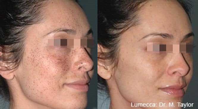 MT_Lumecca_1c_580nm_ShortPulse_StrongCooling_DermaPop_2Intersectingpasses_17J